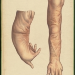 Teaching watercolor of a deformity of the arm caused by a severe burn, and the results of corrective surgery on the same arm