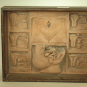 Dickinson-Belskie framed panel model of female sterilization, 1941