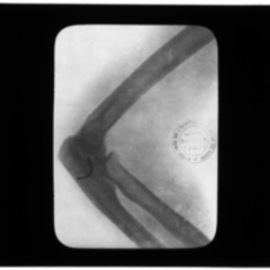 X-ray of curved metal piece in elbow