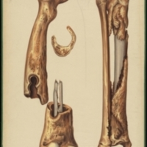 Teaching watercolor of bone deformity or disease