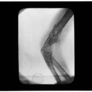 X-ray of arm with scattered shrapnel