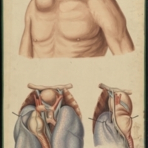 Teaching watercolor of an aneurysm of the aortic arch which pushed through the gap between the clavicle and the rib cage to protrude beneath the skin