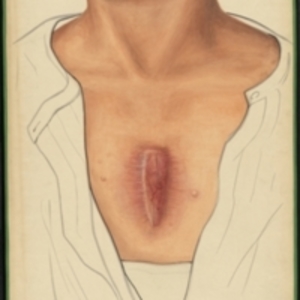Teaching watercolor of an abnormal growth on the sternum of a male subject