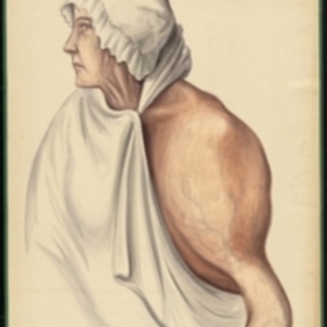 Teaching watercolor of a woman with a large tumor on her humerus