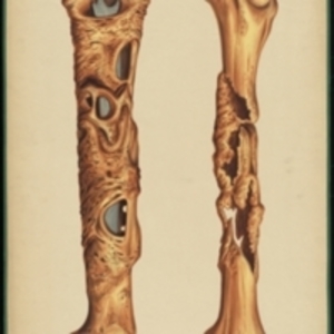 Teaching watercolor of bone deformity or disease