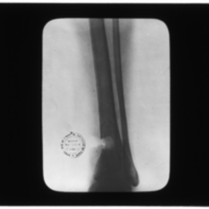 X-ray of hole in bone in tibia