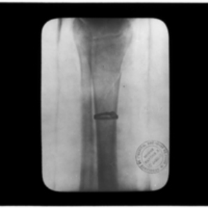 X-ray of surgical strap around tibia