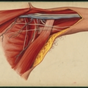 Teaching watercolor of the region of the Axilla on the left side following the removal of the adipose and cellular tissue