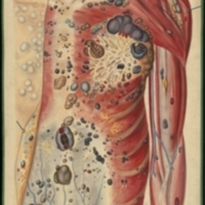 Teaching watercolor showing the torso of a female with cancer of many kinds of tissue and the various sizes and types of tumors