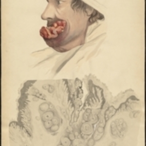 Teaching watercolor of skin neoplasms, a man's head with skin cancer near the mouth, and a magnified view of skin cancer ulcer