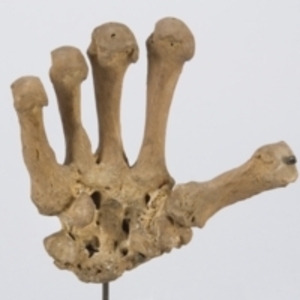 Carpal and metacarpal bones of the right hand demonstrating arthritis of the wrist joint