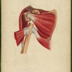 Teaching watercolor of a fracture of the neck of the humerus immediately below the tubercles and above the insertions of the pectoralis major, latissimus dorsi, and teres major muscles