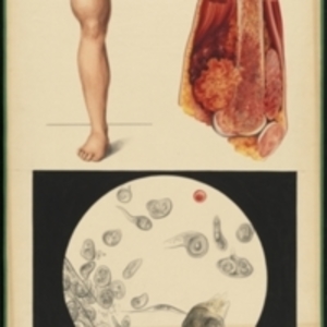Teaching watercolor of a mass on the femur near the knee and a microscopic view of the tissue