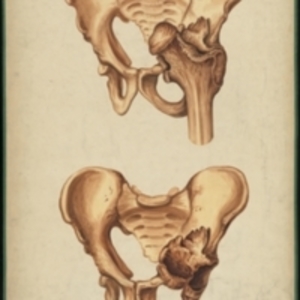Teaching watercolor of damage to the femur and pelvis caused by a dislocated femur