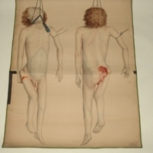 Teaching watercolor of hanging local subject with hip injury, 1848-1854