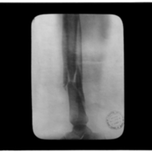 X-ray of broken tibia