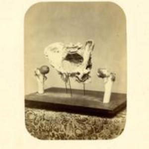 Photographs of Charles Lowell's hip bone mounted on display