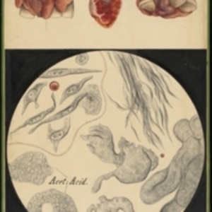 Teaching watercolor of a tumor in the mouth, including exterior views, dissected view, and view of tissue under a microscope