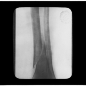 X-ray of sliced tibia