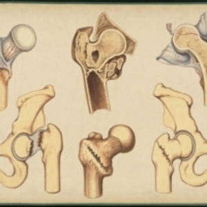 Teaching watercolor of healthy and injured femurs