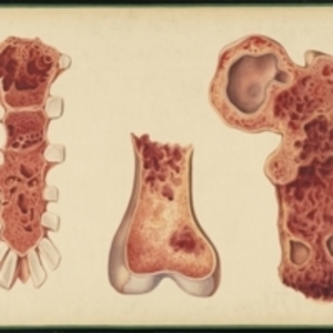 Teaching watercolor of osteomalacia