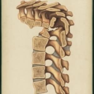 Teaching watercolor showing a cross section of the vertebrae in an angular curvature of the spine