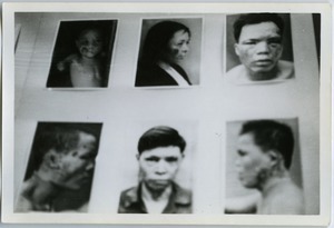 Facial burns from United States napalm attacks
