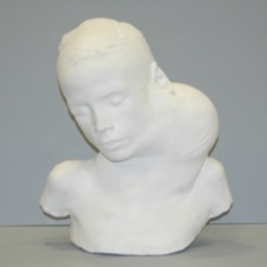 Cast of child with tumor, 1876 [WAM 04635]
