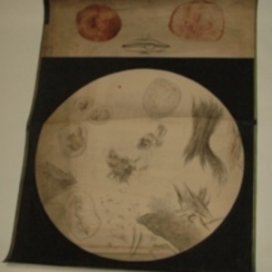 Teaching watercolor of mass on mouth, external and microscopic views, 1848-1854