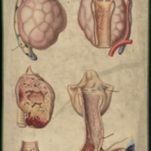 Teaching watercolor of diseases of the larynx, trachea, and thyroid gland