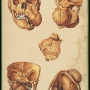 Teaching watercolor of five views of a tumor of the skull and jaw