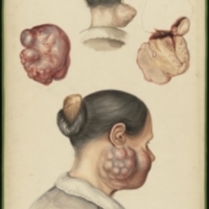 Teaching watercolor of a tumor on the face of a woman