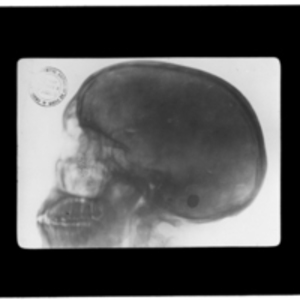 X-ray of skull in profile