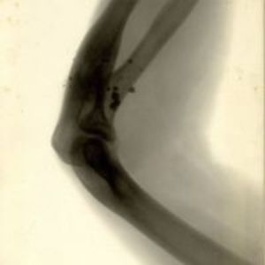 Radiograph of the right elbow of Henry Pickering Bowditch, showing fragments of bullet