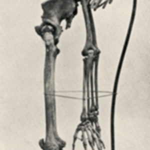 Young adult skeleton with tuberculosis spondylitis, commonly referred to as Pott's disease