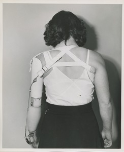 Woman with artificial arm