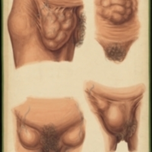Teaching watercolor of the external signs of various types of hernias in females