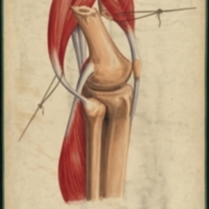 Teaching watercolor of a fracture of the femur immediately above the condyles