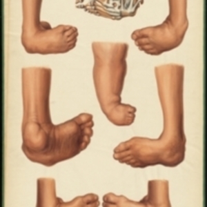 Teaching watercolor of clubfeet