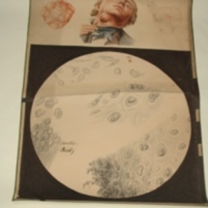 Teaching watercolor of external and microscopic view of human cells from mass in neck, 1848-1854