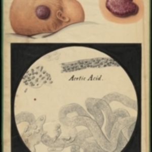Teaching watercolor of a large growth on a child's head and a microscopic view of the tissue