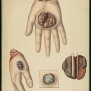 Teaching watercolor of cancer on the hand