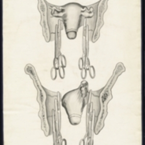 Teaching watercolor of vaginal hysterectomy with clamps