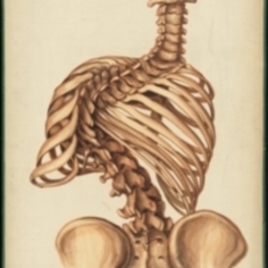 Teaching watercolor showing a severely distorted spine and ribs