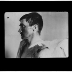 Patient with shoulder wound in profile