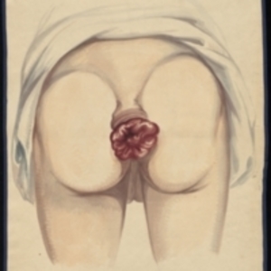 Teaching watercolor of an unknown female subject with a rectal prolapse