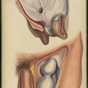 Teaching watercolor of inguinal hernia