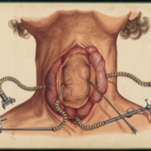 Teaching watercolor of the removal of a cancerous goiter