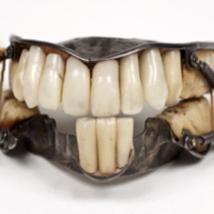 Silver Dentures Attached by Buccal Wire Springs