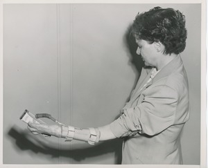 Woman with missing thumb demonstrating prosthesis